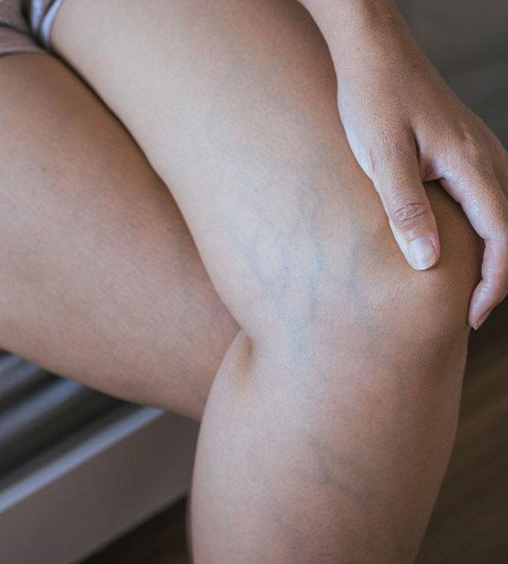 Best Doctor for Varicose Veins in Delhi NCR
